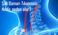 Şah damarı tıkanması nedir, neden olur, belirtileri nelerdir, teşhis ve tedavi yöntemleri