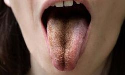 Kıllı Dil Hastalığı: Nedenleri, Belirtileri ve Tedavi Yöntemleri