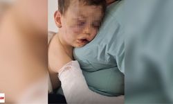 Annesinin Erkek Arkadaşı Tarafından Darp Edilen 2 Yaşındaki Bebek Hastanelik Oldu
