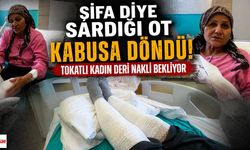 Şifa Diye Sardığı Ot Kabusa Döndü! Tokatlı Kadın Deri Nakli Bekliyor
