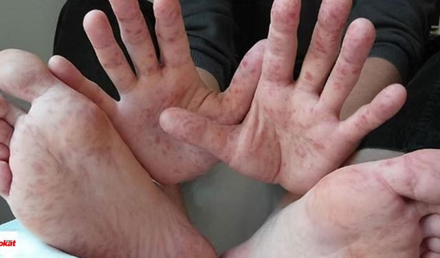 El ayak ağız hastalığında çocuklarda bu belirtilere dikkat
