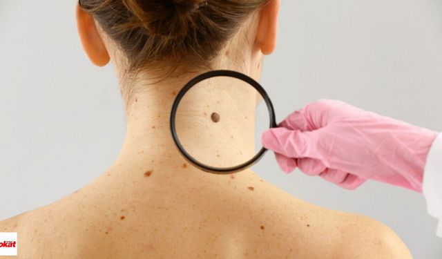Gök Medrese’de Ücretsiz Dermatoloji Taraması: Uzmanlar Uyaracak