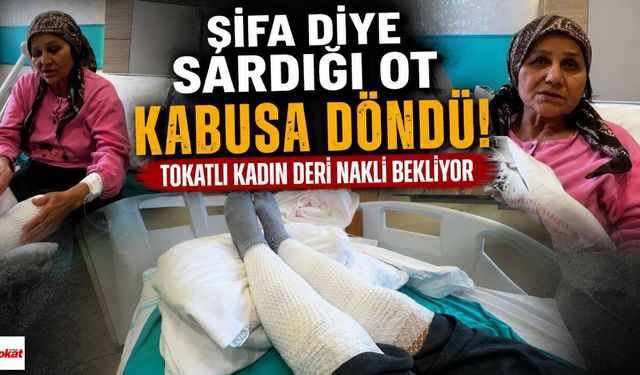 Şifa Diye Sardığı Ot Kabusa Döndü! Tokatlı Kadın Deri Nakli Bekliyor