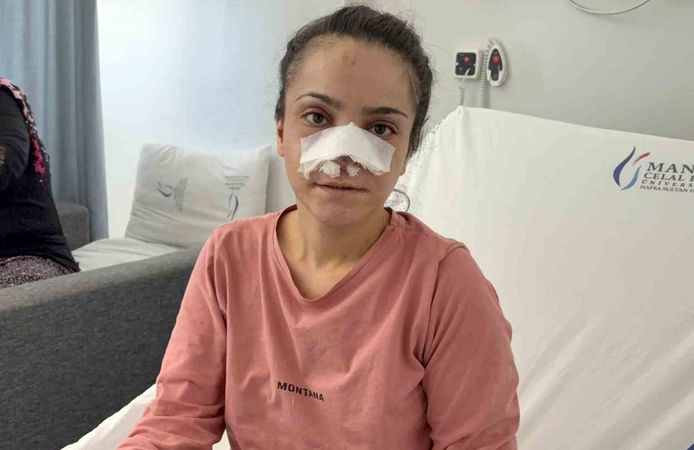 Eşinin kopardığı burnu başarılı operasyonla yerine dikildi