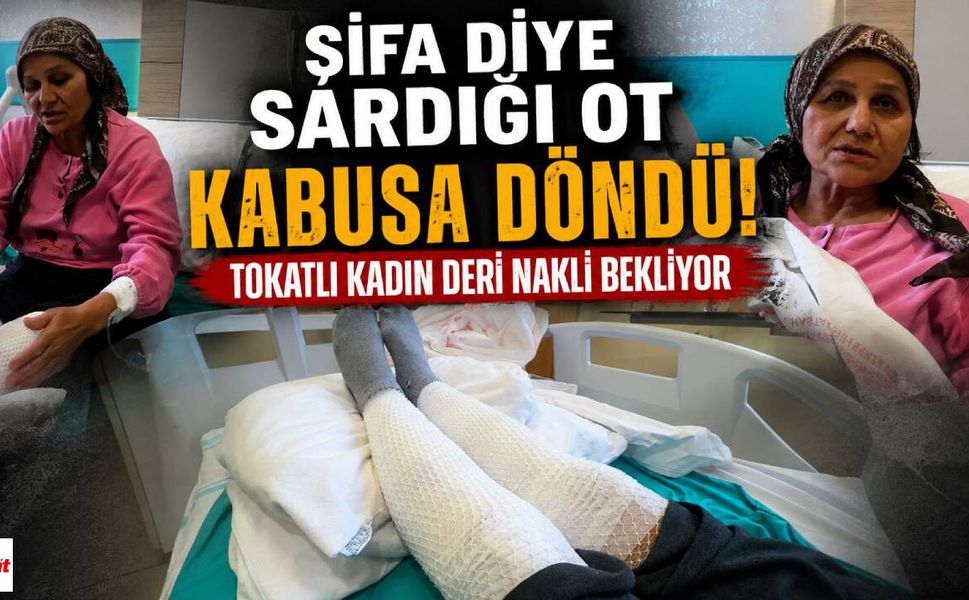 Şifa Diye Sardığı Ot Kabusa Döndü! Tokatlı Kadın Deri Nakli Bekliyor